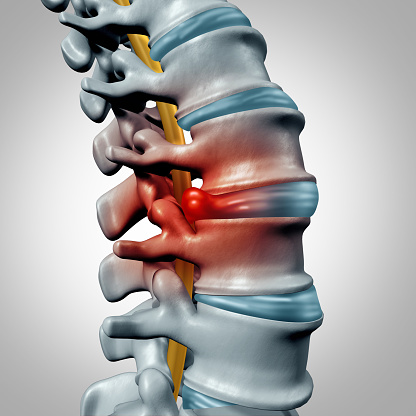 Herniated Discs in Madison, OH